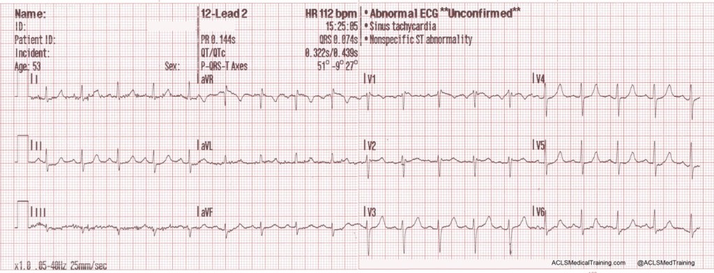 12-Lead ECG