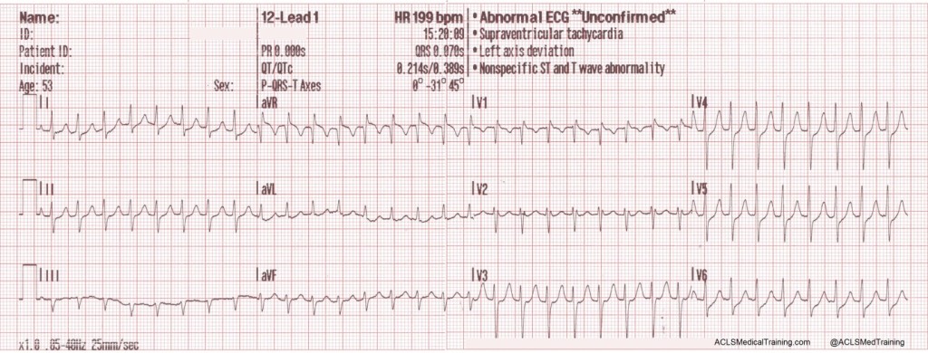 A 12-lead ECG is obtained by paramedics