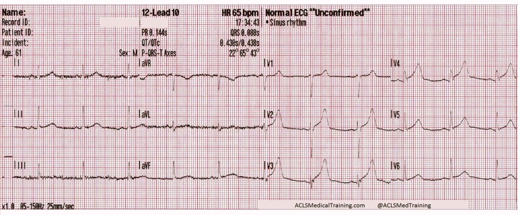 12-Lead ECG