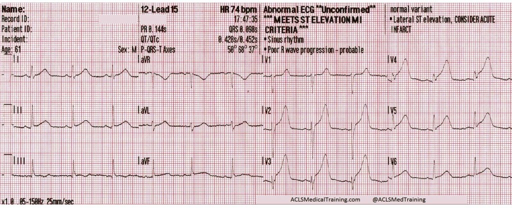 Meets ST Elevation MI Criteria