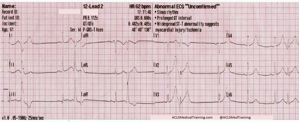 R-on-T PVCs