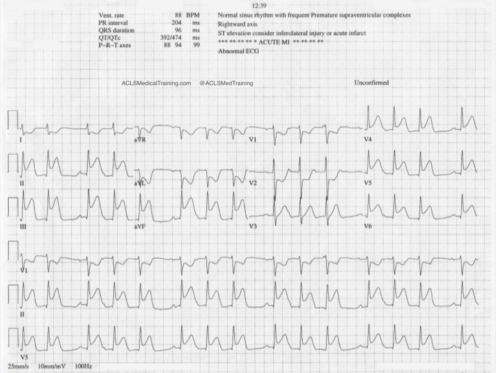 Second degree AV block type 1