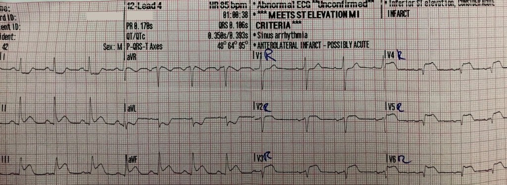 RV infarction 2