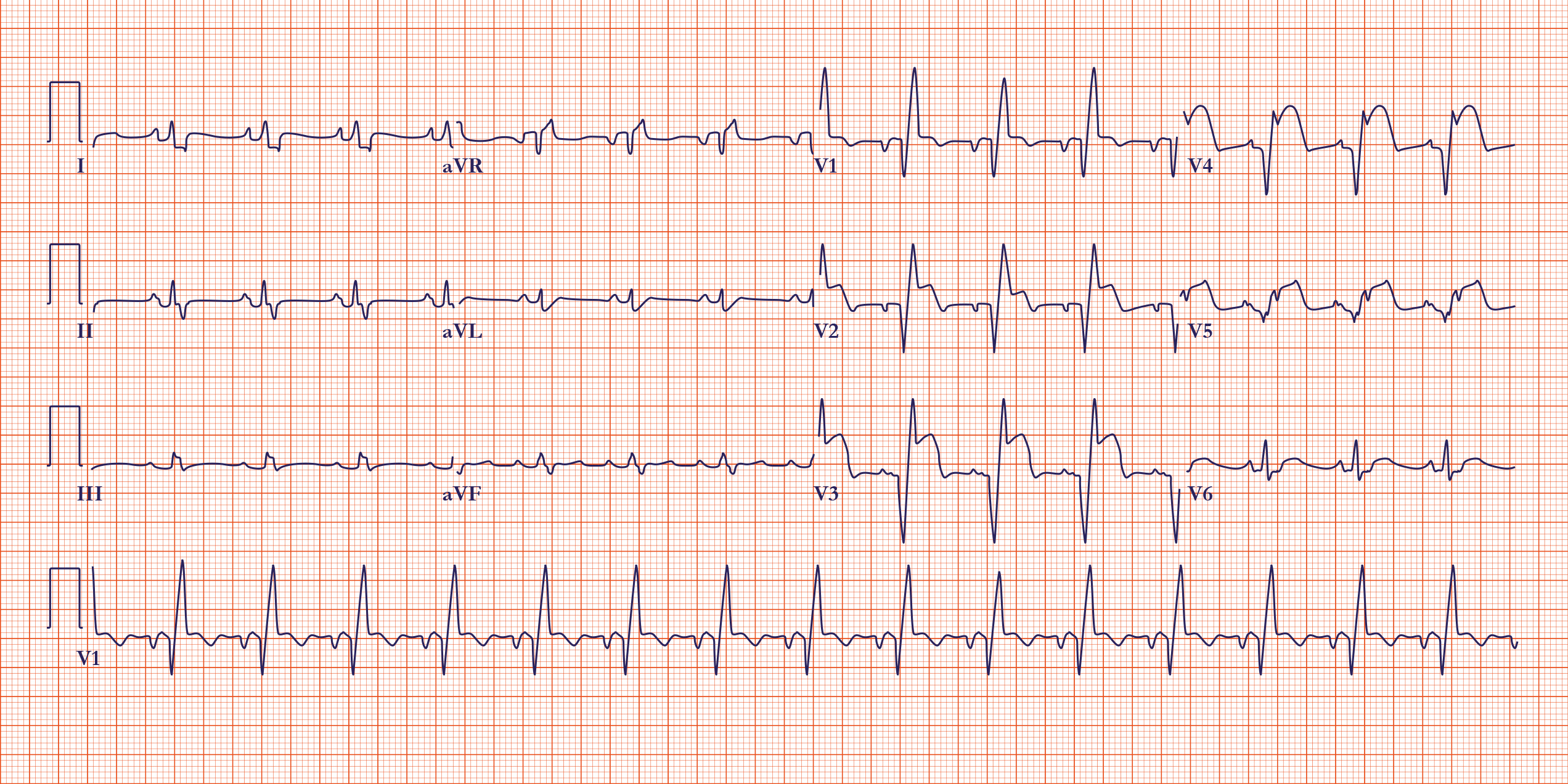 Sinus Rhythm 1